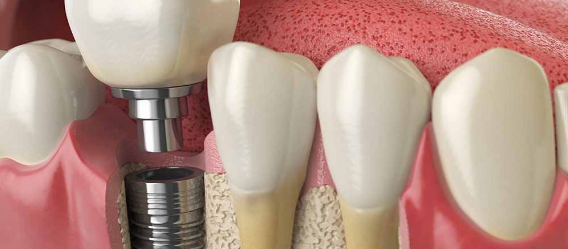 $399 Dental Implants